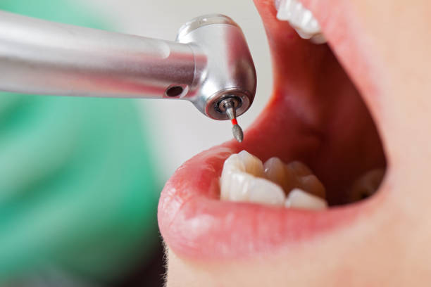 Best Dental Abscess Treatment in Fairburn, GA